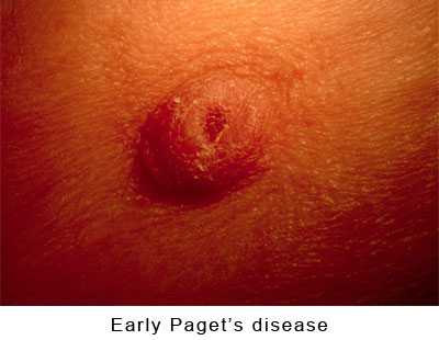 Например, при воспалите льном раке молочной железы могут возникать и поражения эпидермиса, в результате чего на коже появится оранжевая и красная сыпь, изза которой поверхность груди станет горячей