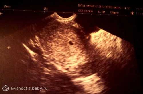 Если же и на этот раз нет ни эмбриона, ни сердцебиения, говорят об анэмбрионие