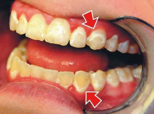 Зубы могут быть индикатором возраста