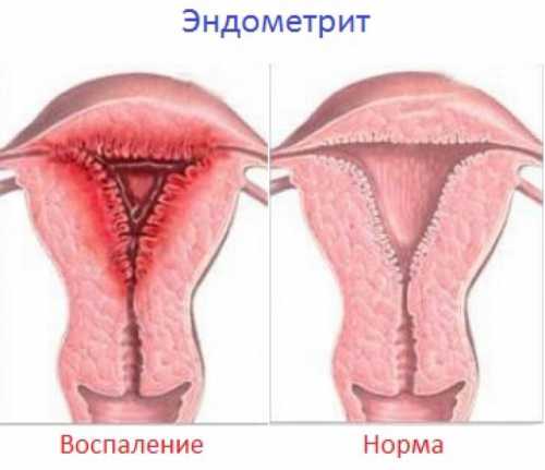 Эндометрит воспаление матки